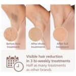 Philips Lumea Prestige BRI949/00 IPL Hair Removal Device